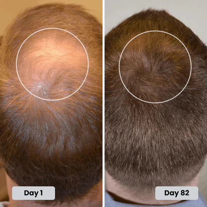 Red Light Therapy Hat + Regrowth Hair Kit